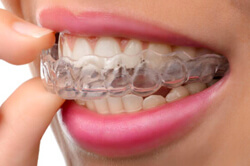 Invisalign