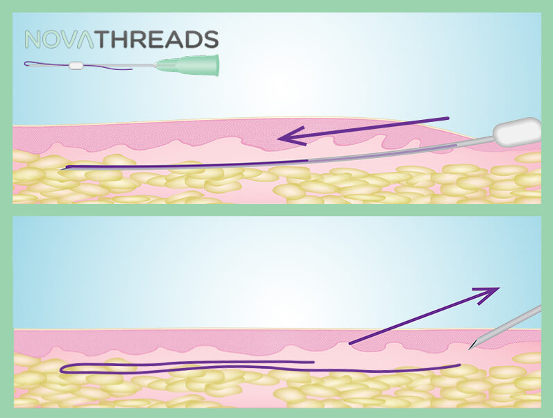 NOVATHREADS no incisions